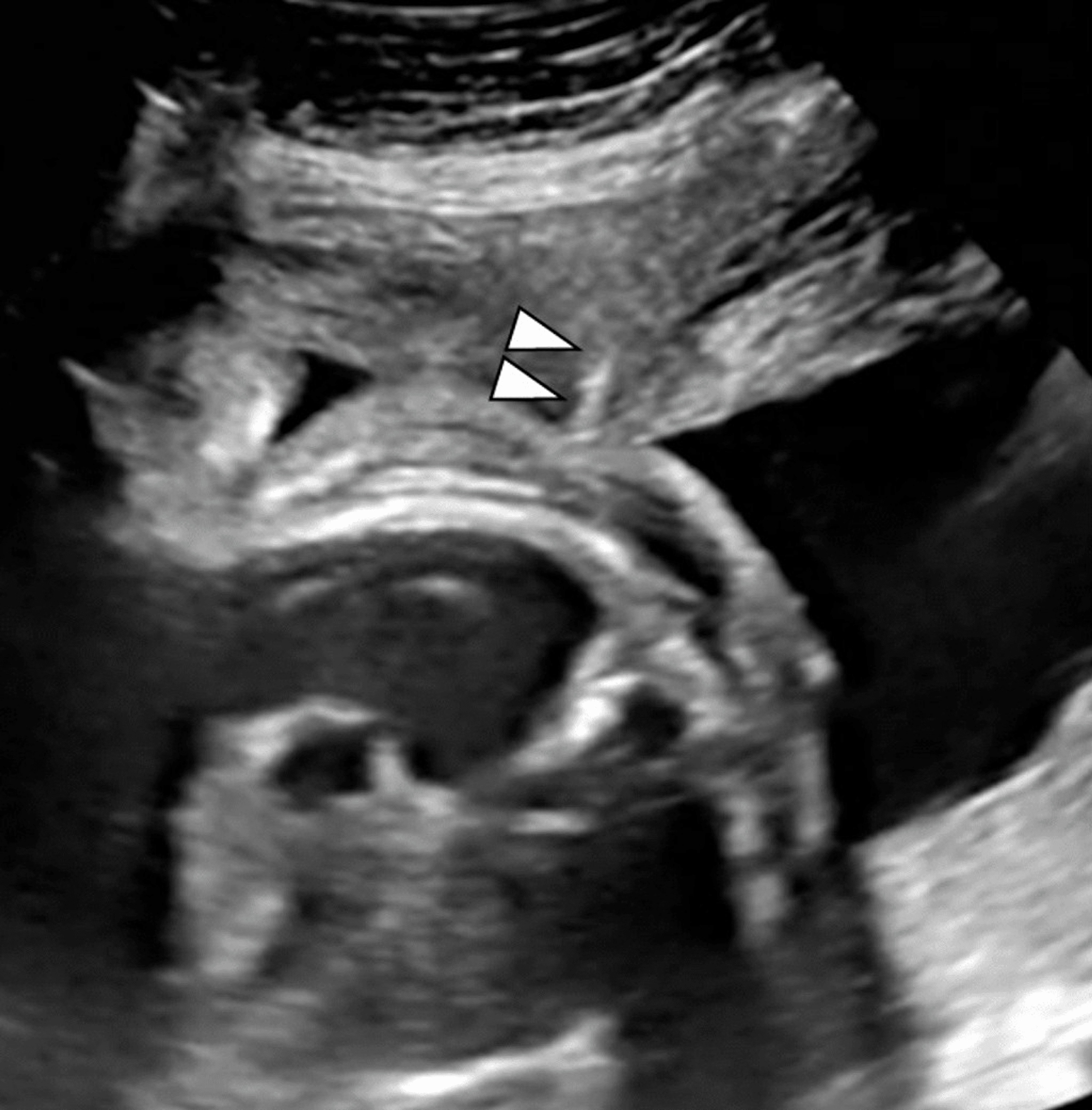 Cureus | Fetal Distress and Neonatal Death After Thoracoamniotic ...