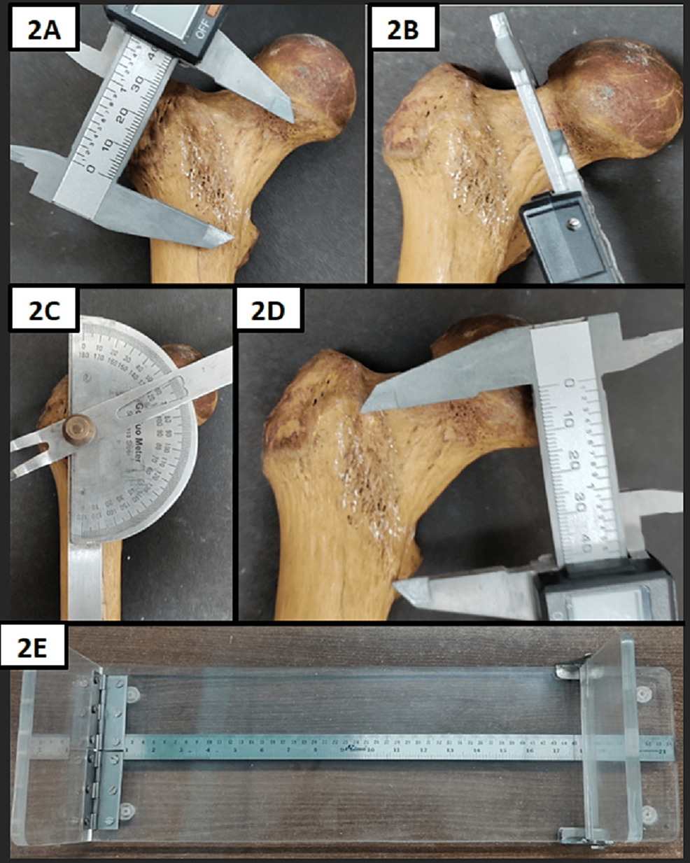 Cureus Morphometric Analysis Of The Proximal Femur With Its Clinical Correlation In Eastern