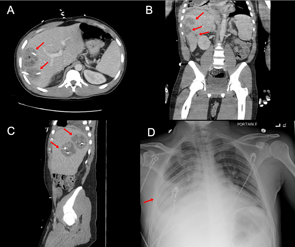 Transverse-(A),-coronal-(B),-and-sagittal-(B)-anatomic-projections-of-contrast-CT-abdomen-and-pelvis-demonstrating-three-complex-cystic-hepatic-lesions-(red-arrows);-(D)-Chest-X-ray-anteroposterior-view,-showing-interstitial-worsening-in-the-aeration-of-the-right-lower-lobe-associated-with-increase-in-the-right-pleural-effusion-(red-arrow)