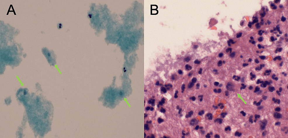 Pathology-microscope-images-of-pleural-fluid:-(A)-Cell-block,-(H&amp;E,-x40):-rare-ill-preserved-trophozoites-(green-arrow),-along-with-abundant-neutrophils-and-mild-reactive-mesothelial-cells;-(B)-Thin-prep-cytology,-(60X):-possible-occasional-(spores)-corresponding-with-amebiasis-(green-arrow).