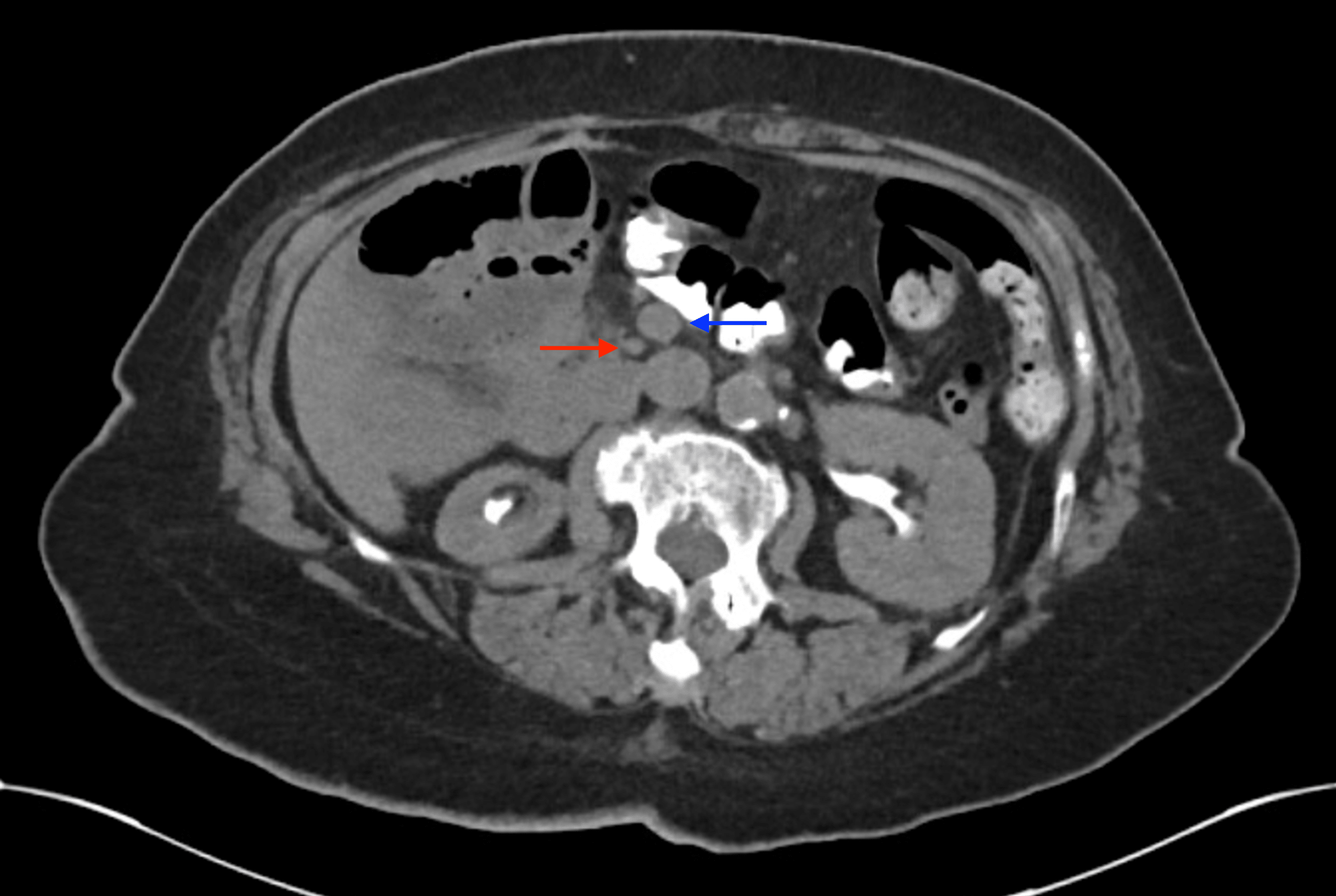 Cureus | Incidental Discovery of Nonrotation in a Patient With ...