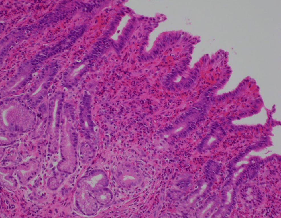 is-eosinophils-6-5-high-normal-or-dangerous-what-does-eosinophils