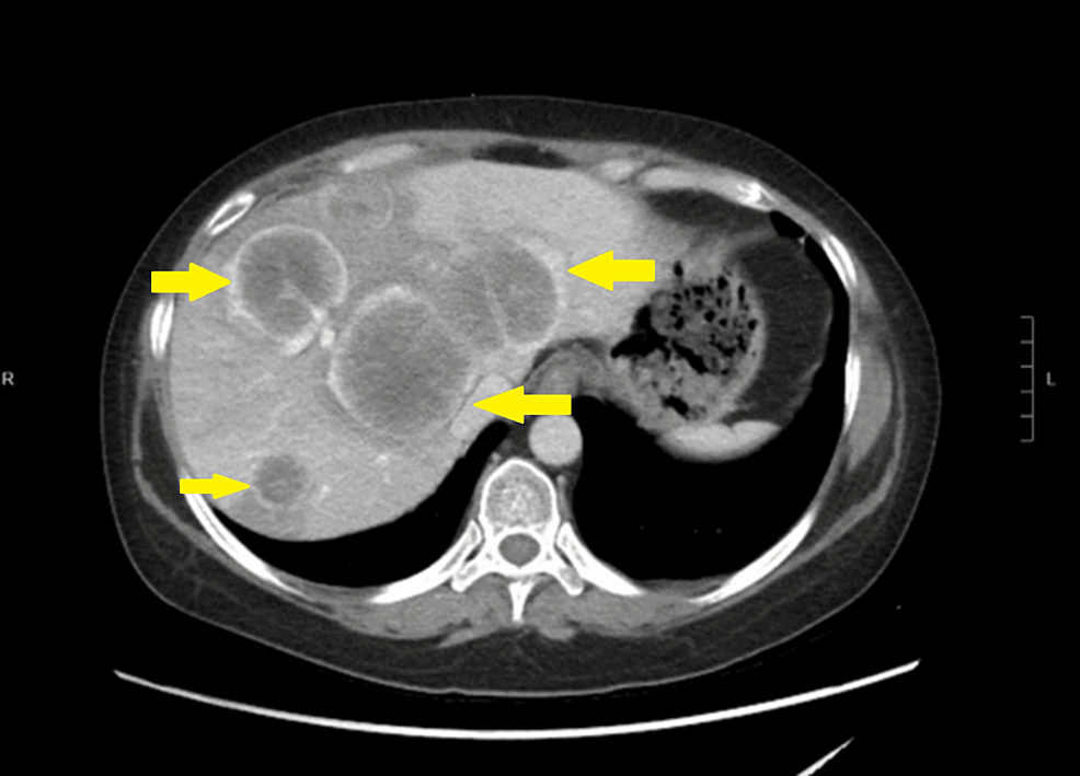 Abdomial-CT-with-contrast-done-one-month-prior-showed-evidence-of-metastatic-disease-including-multiple-large-liver-lesions.