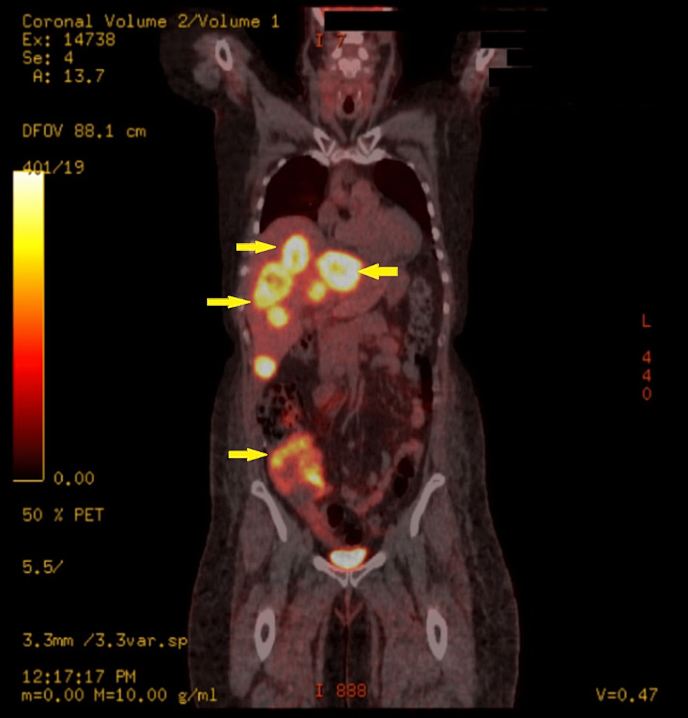 PET/CT-demonstrated-the-presence-of-hypermetabolic-lesions-in-the-liver-and-right-lower-quadrant-of-the-abdomen.
