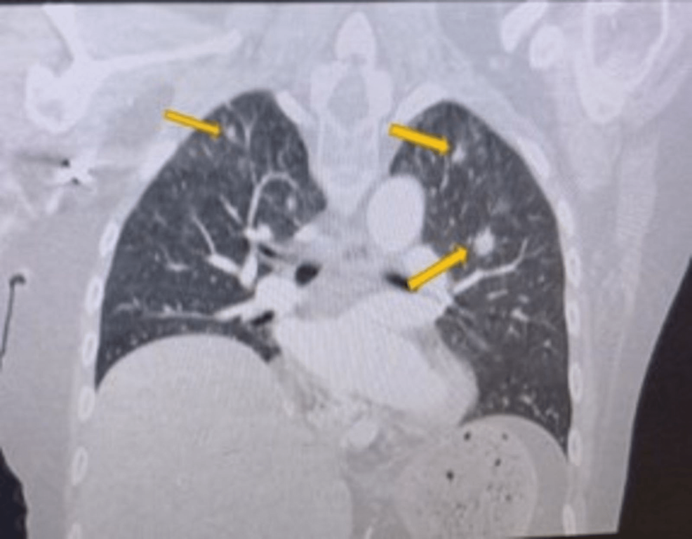 Contrast-enhanced-chest-CT-showing-bilateral-noncalcified-lung-nodules.