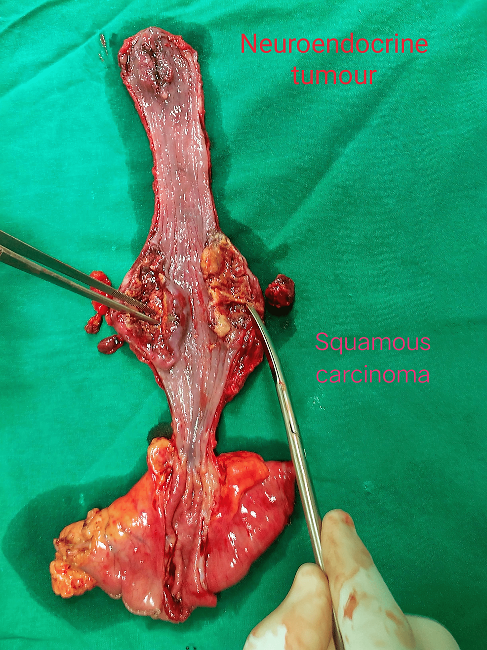 Specimen-of-Esophagus-and-Upper-Stomach-Removed-in-Continuity