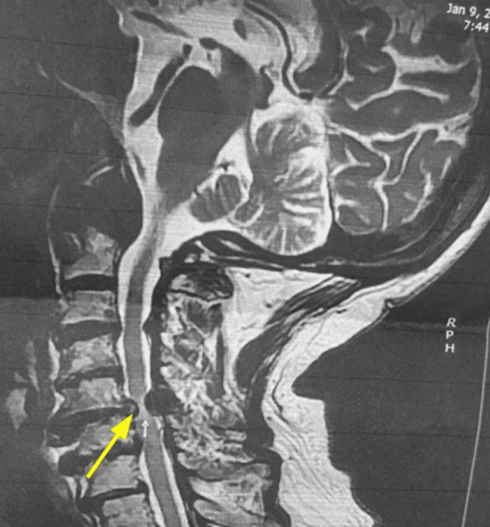 Cervical Stenosis Balance Issues