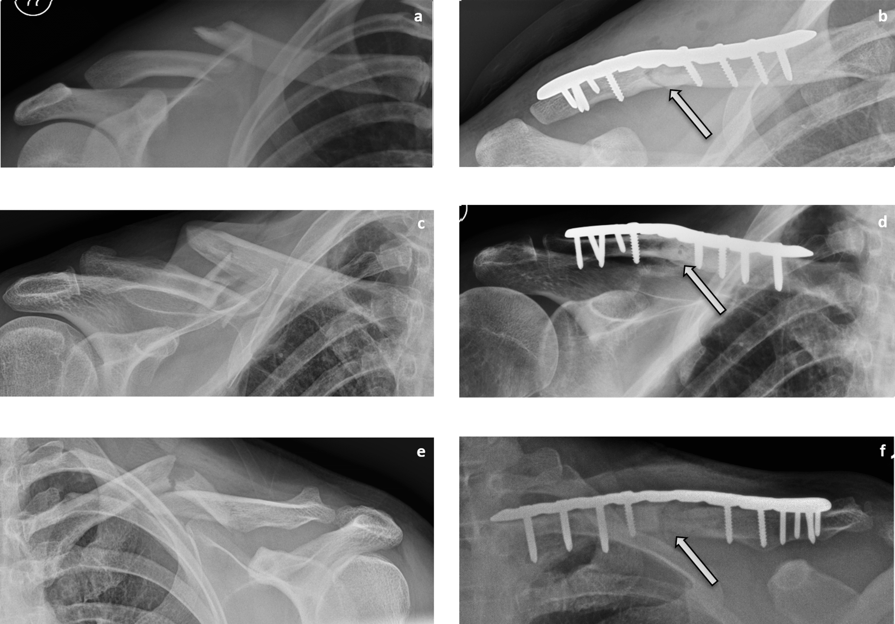 Cureus | Surgical Fixation Of Clavicle Shaft Fractures Using Superior ...