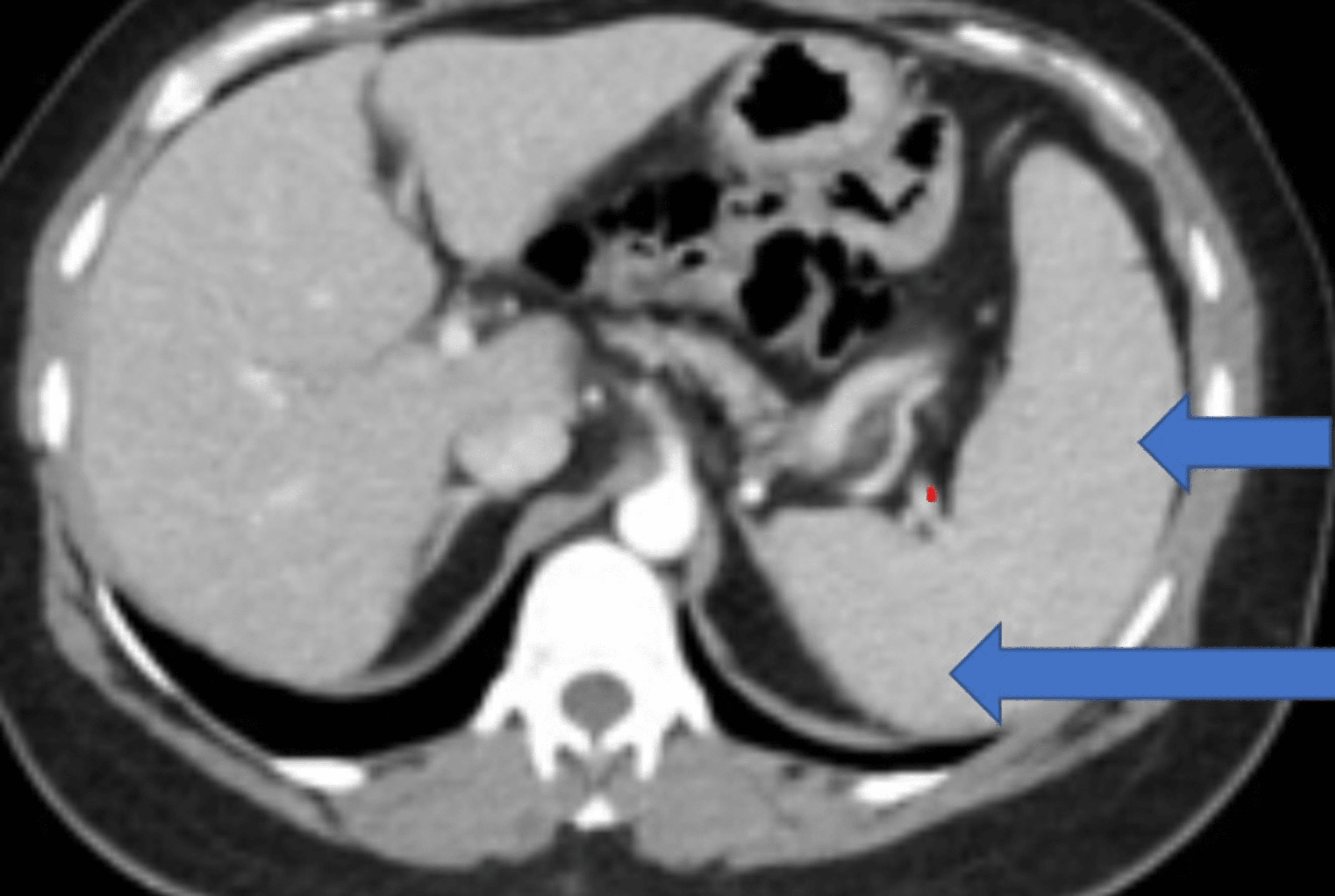 portal hypertension histology