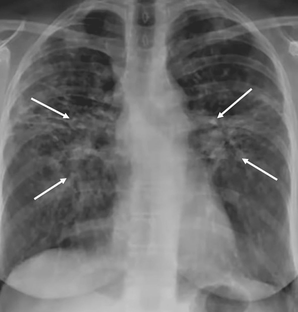 Clopidogrel-Related Interstitial Lung Illness: A Case Document and Literature Assessment