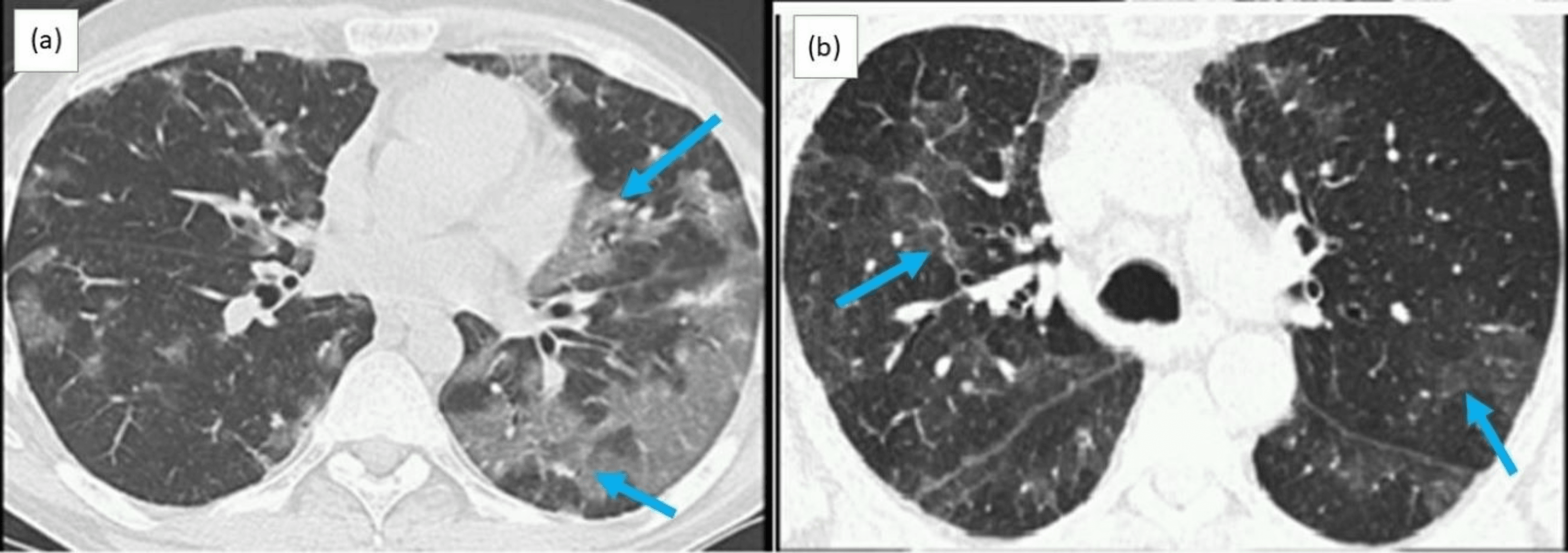 Cureus ClopidogrelAssociated Interstitial Lung Disease A Case