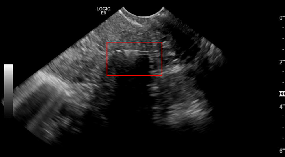 Retained Copper Intrauterine Device Fragment in Pregnancy A Case