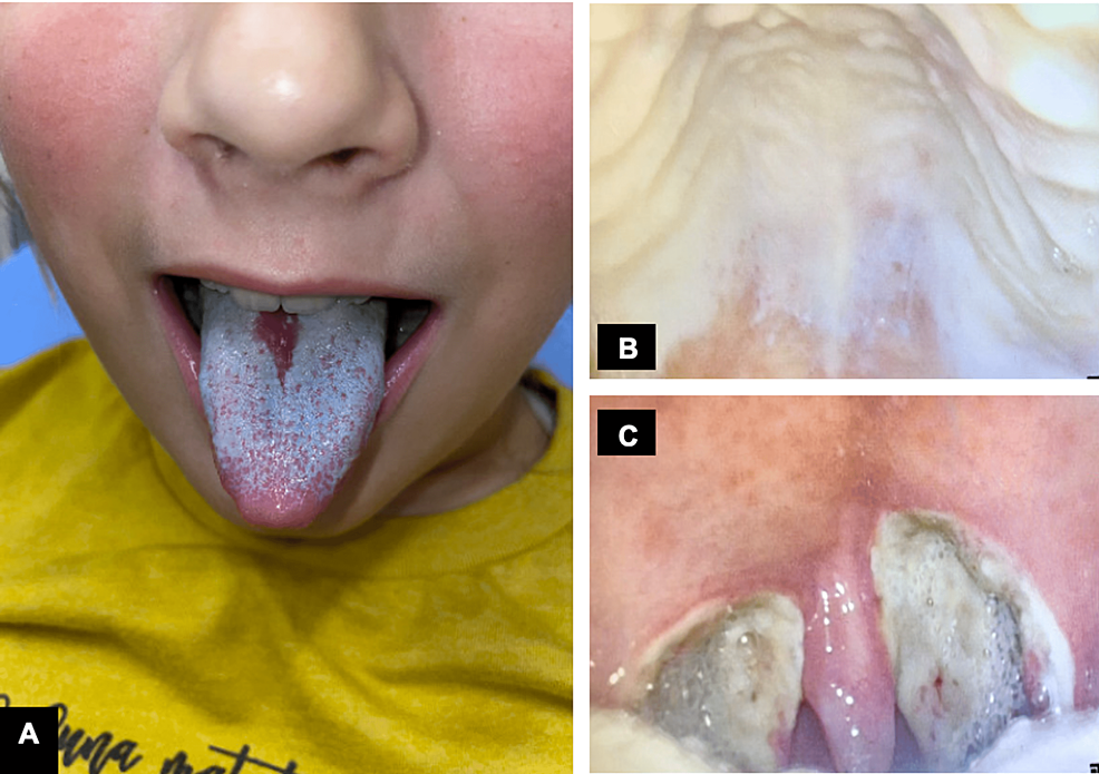 Postoperative Pain Exacerbation After Adenotonsillectomy Due To Oral 