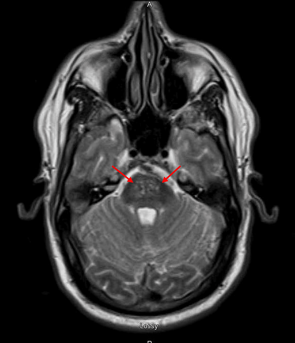 Cureus | Central Pontine Myelinolysis: A Case Report of Persistent ...