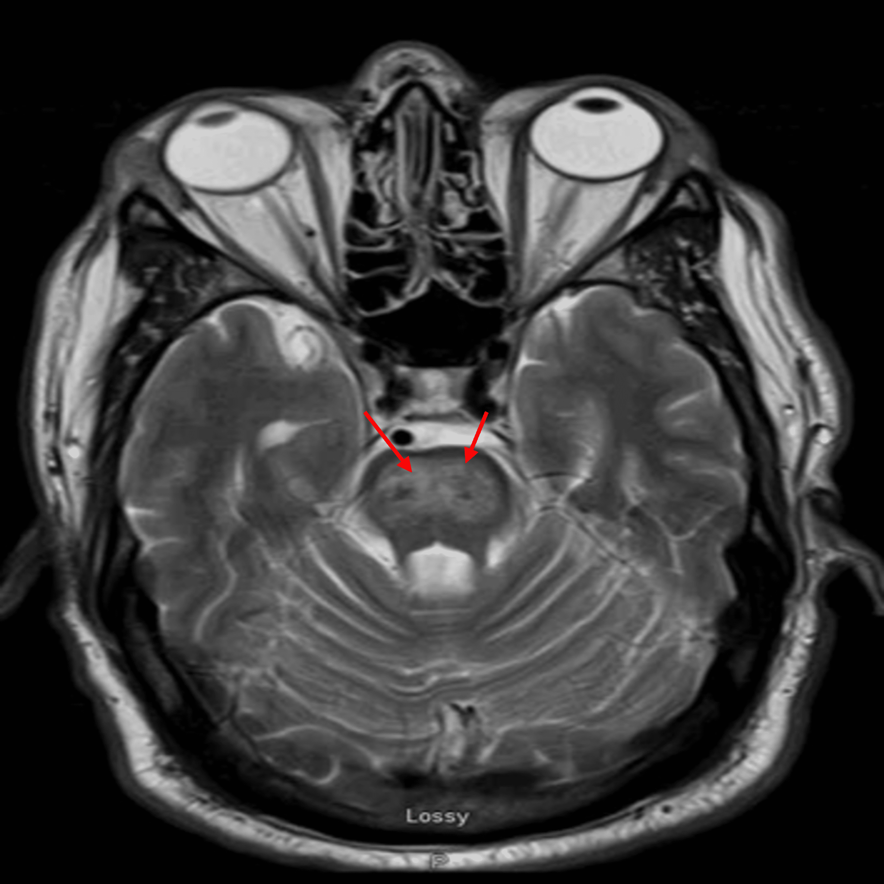 Cureus Central Pontine Myelinolysis A Case Report Of Persistent