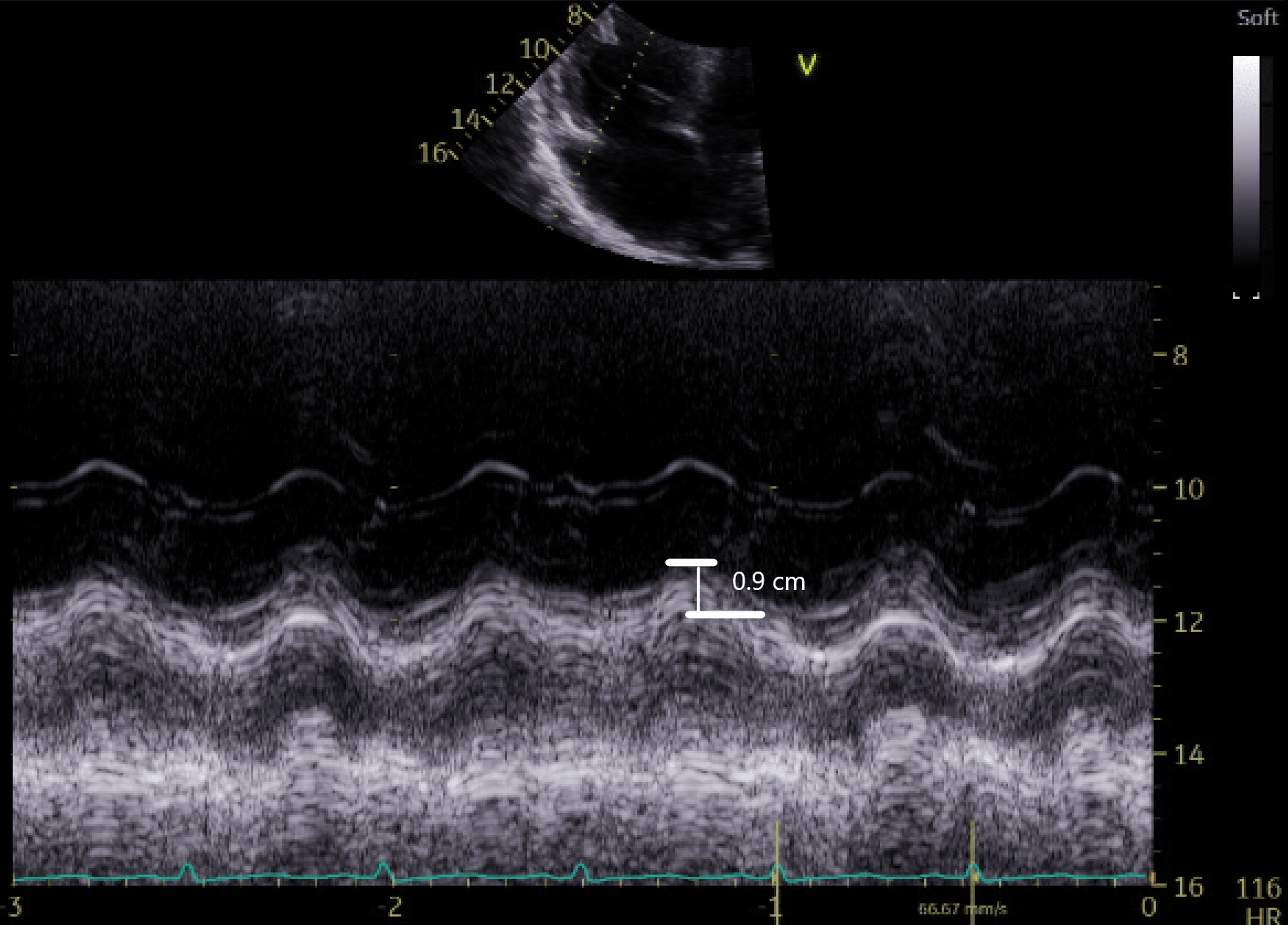 Use of PointofCare Ultrasound and FocusAssessed Transthoracic Echocardiography to Diagnose