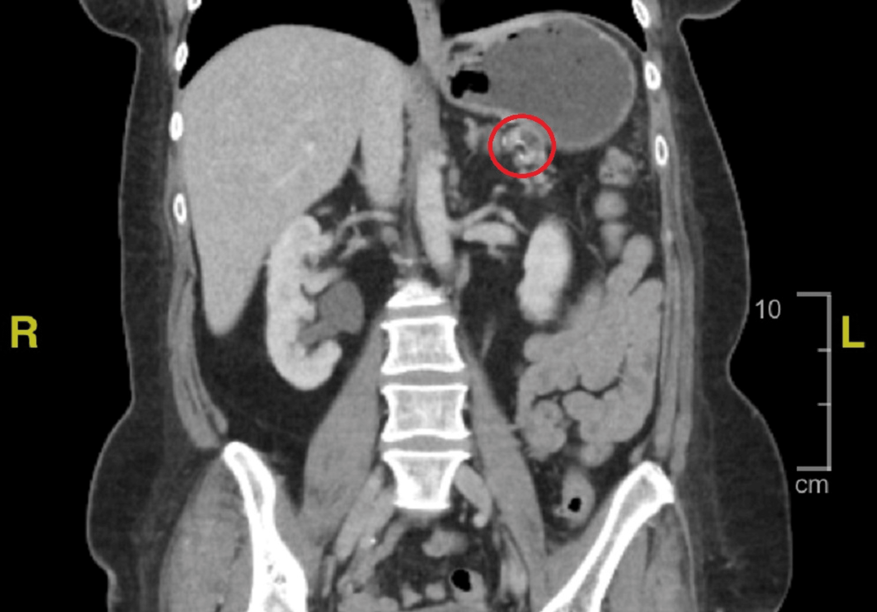 A Rare Case Of Splenic Artery Thrombosis Provoked By ...