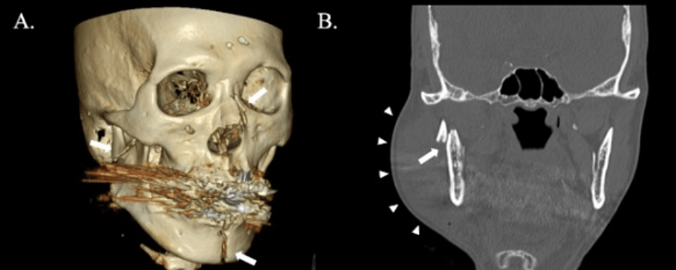 Facial-computerized-tomography-(CT)-on-admission