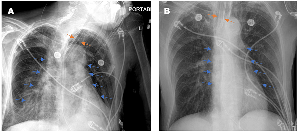 Two-PCXRs-from-a-single-floor-patient-taken-at-different-times-of-the-same-day.-The-rotated-film-(A)-grossly-exaggerates-the-cardiomediastinal-silhouette-(blue-arrows)-and-alters-the-appearance-of-endotracheal-tube-positioning-(orange-arrows).