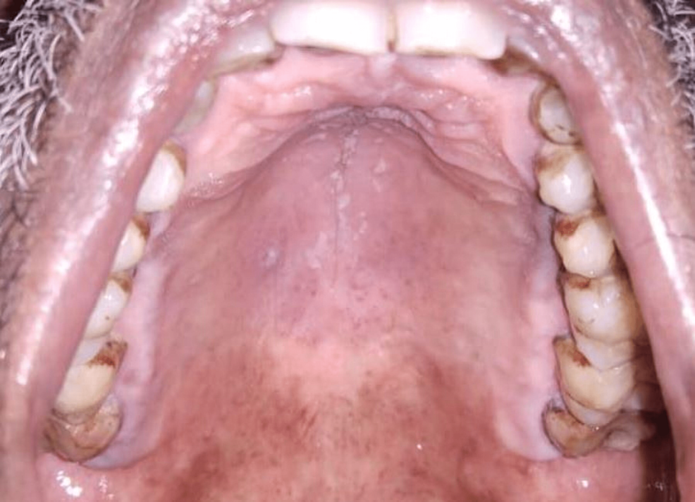 Follow-up-after-three-days-showed-resolution-of-the-lesion-on-the-hard-palate