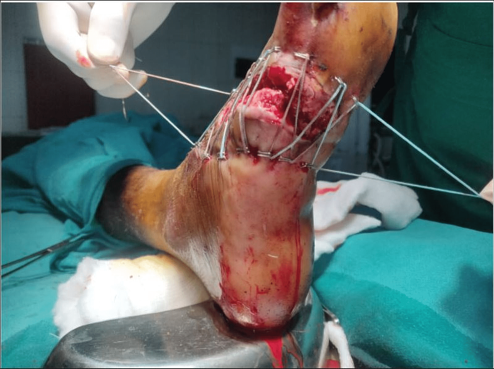 PRP-infiltration-and-application-of-shoelace-suture---plantar-view