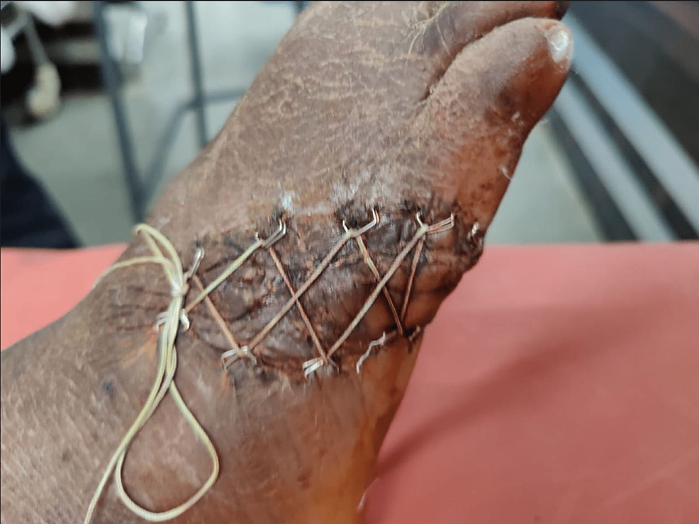 Final-follow-up-image-of-the-wound-after-two-weeks-with-tightening-of-shoelace-every-48-hours-and-PRP-infiltration-every-96-hours---superior-view