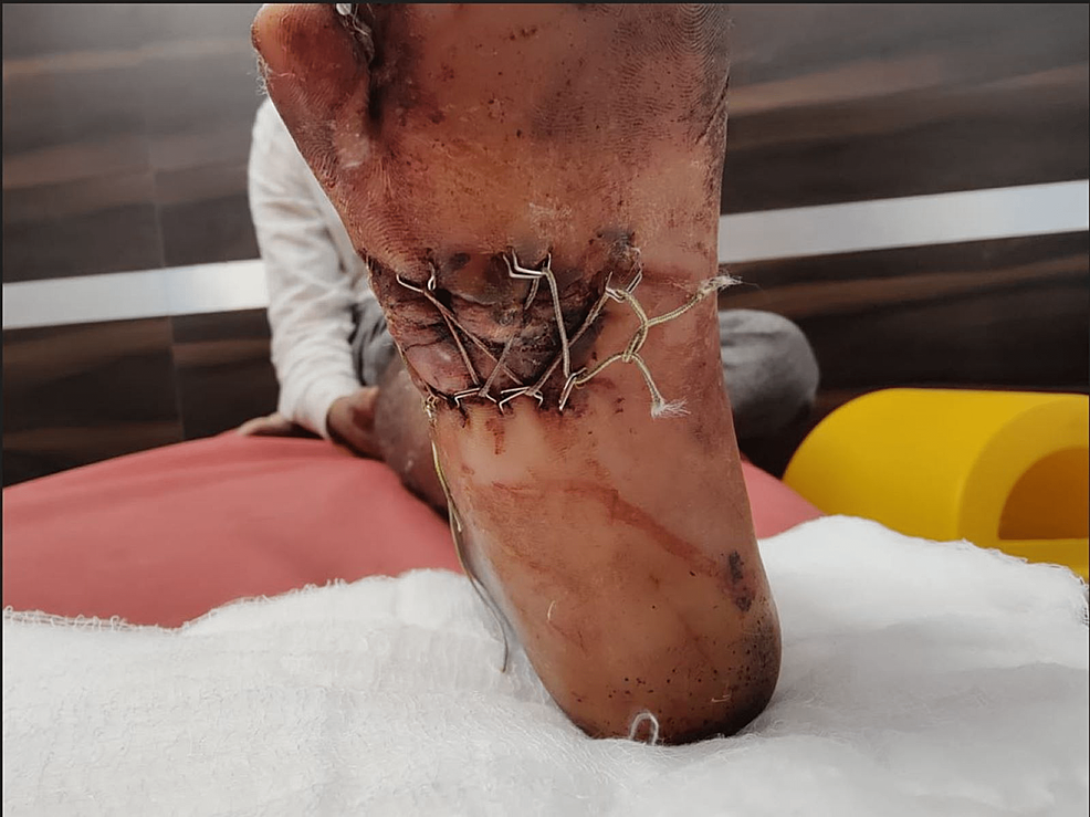 Final-follow-up-image-of-the-wound-after-two-weeks-with-tightening-of-shoelace-every-48-hours-and-PRP-infiltration-every-96-hours---plantar-view