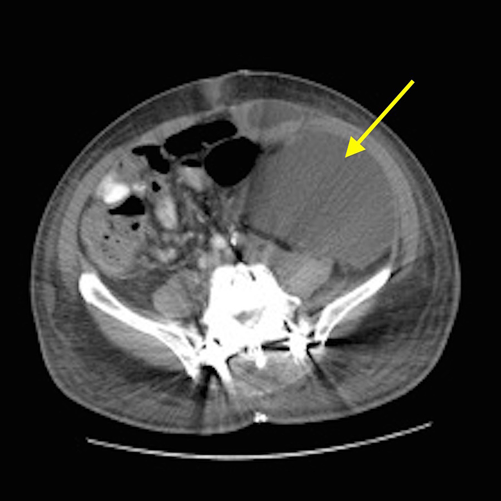 Computed-tomography-(CT)-scan-of-the-abdomen-and-pelvis.