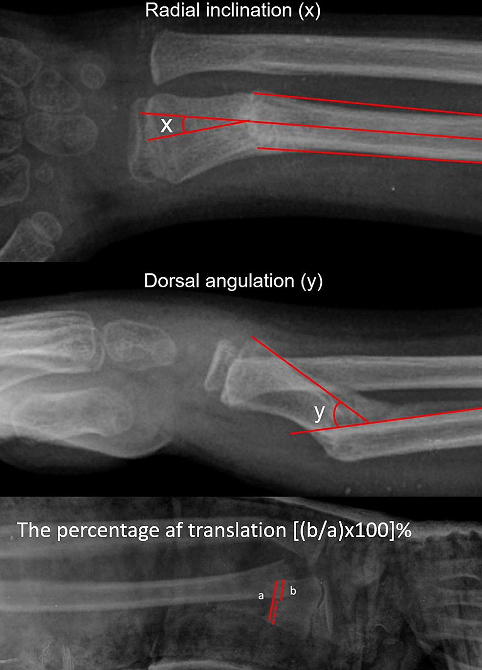 Distal Radius Fracture With Dorsal Angulation