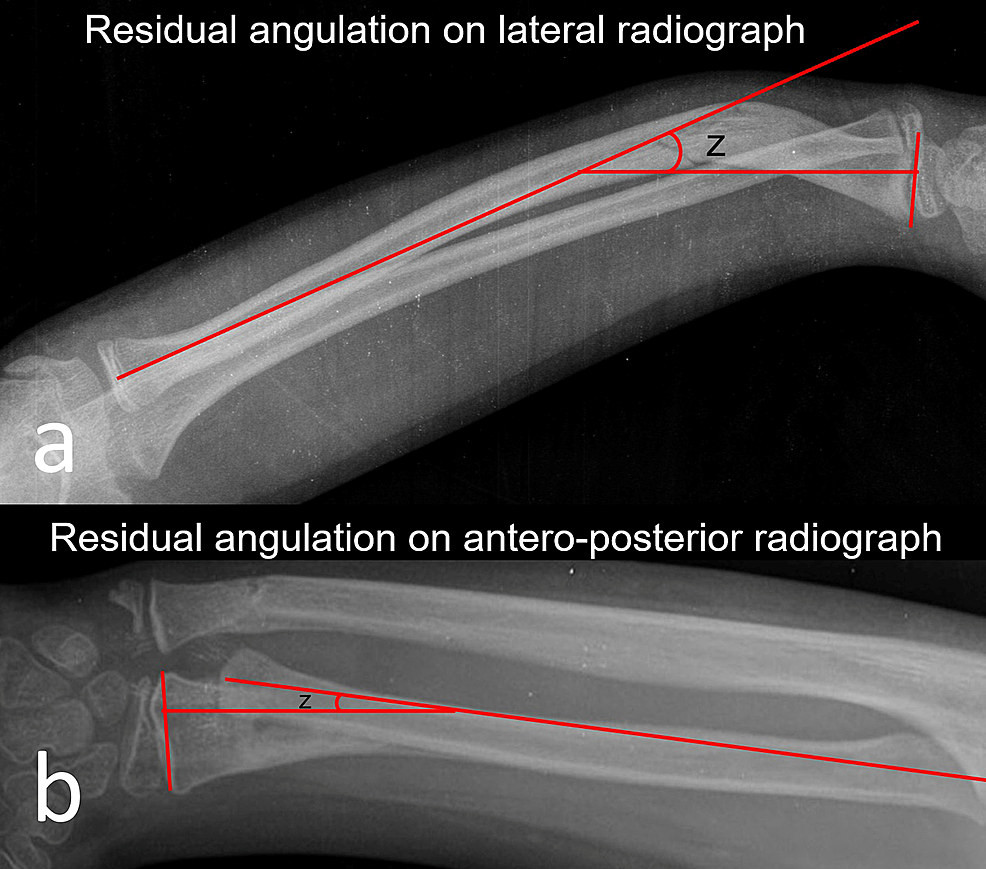 Distal Radial Metaphyseal Fracture
