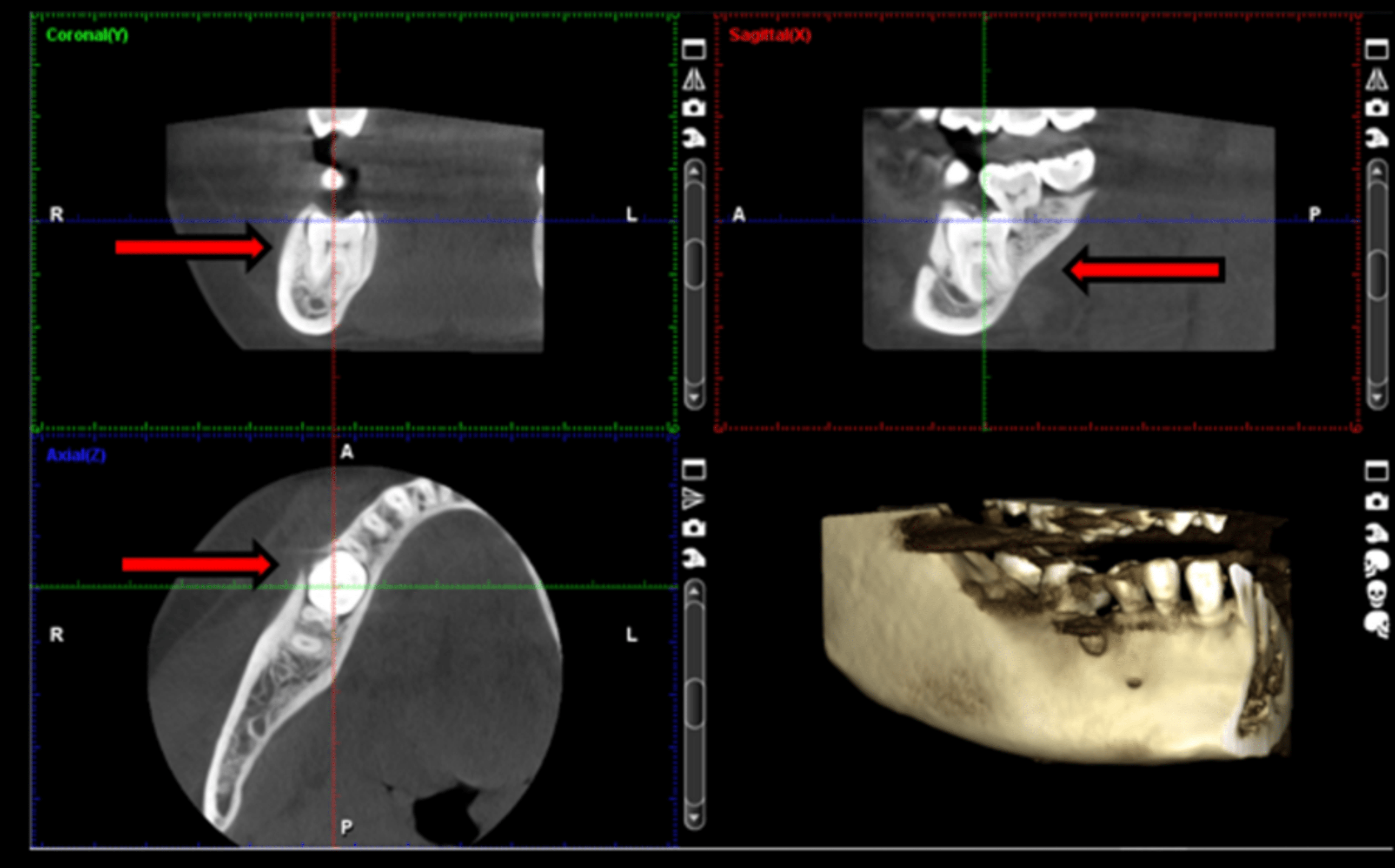 Cureus Impacted Mandibular First Molar A Rare Riddle