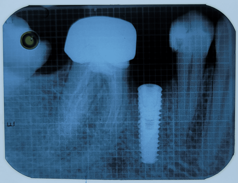 Combined Effect of PlateletRich Fibrin Matrix (PRFM) and Demineralized