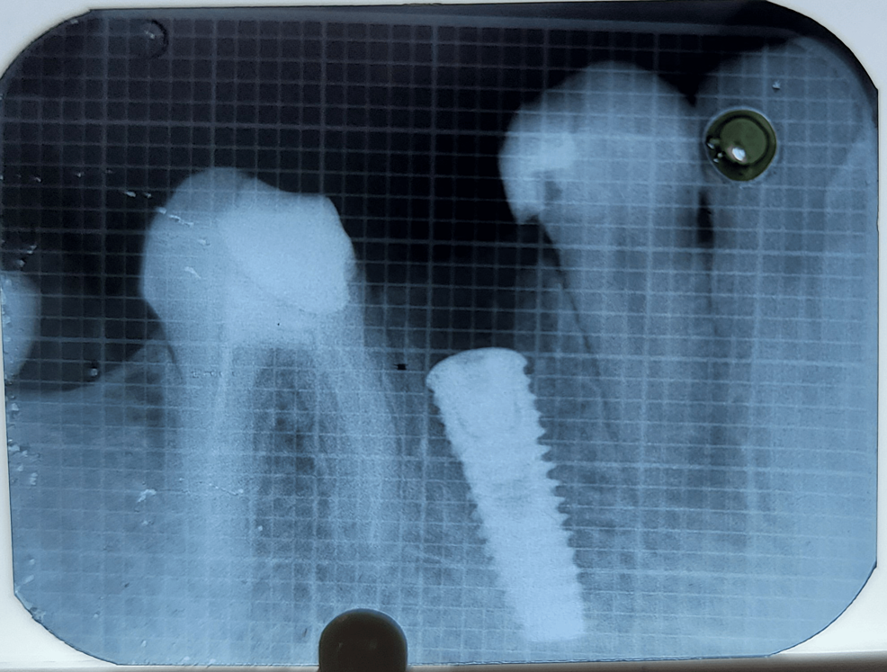 Cureus Combined Effect of PlateletRich Fibrin Matrix (PRFM) and