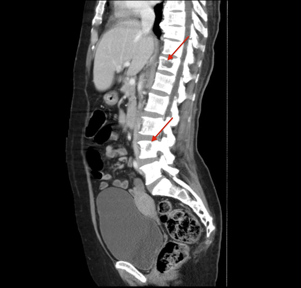 Cureus | Malignant Pheochromocytoma with Widespread Bony and Pulmonary Metastases