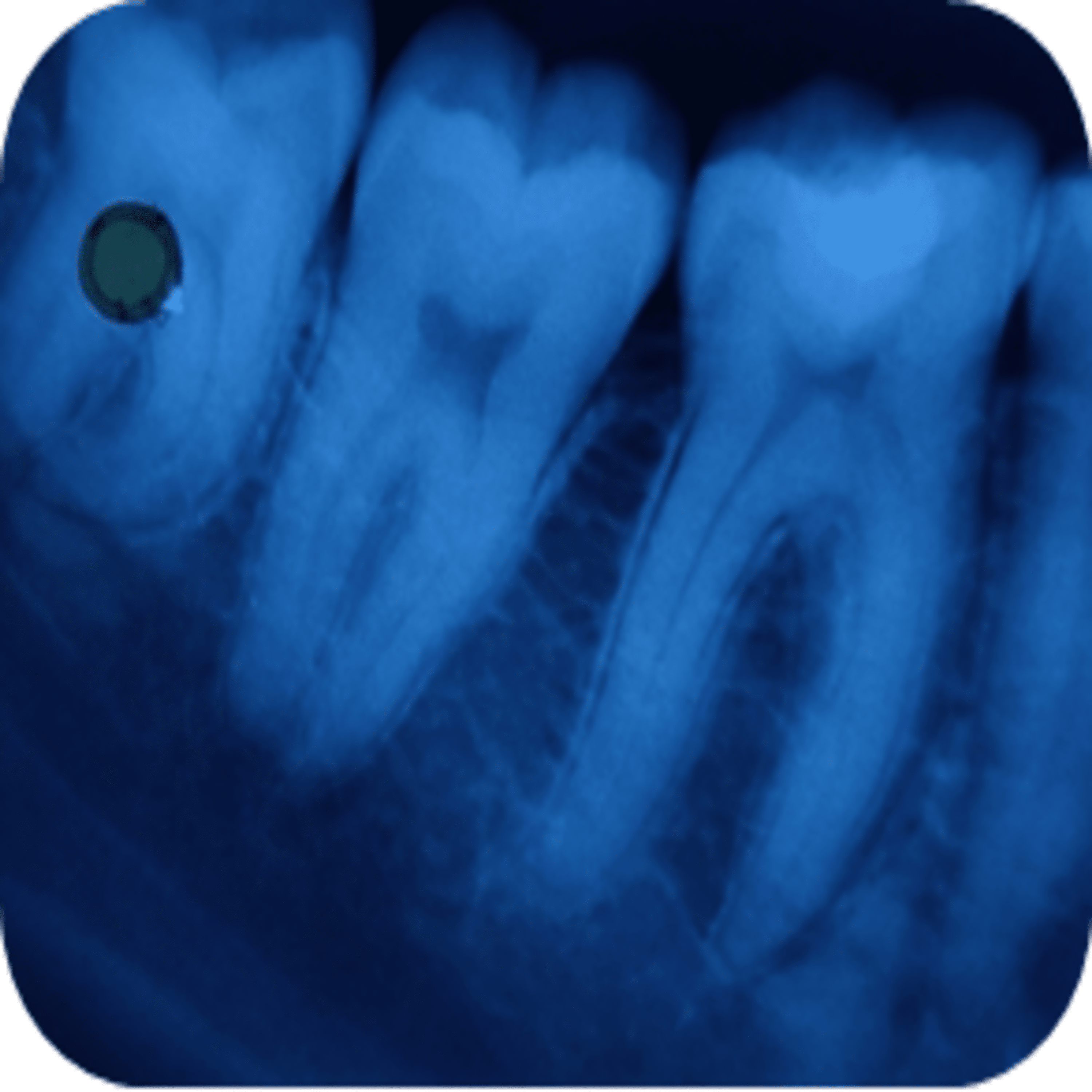 Cureus | Comparative Evaluation of the Efficacy of Light-Cured Calcium ...