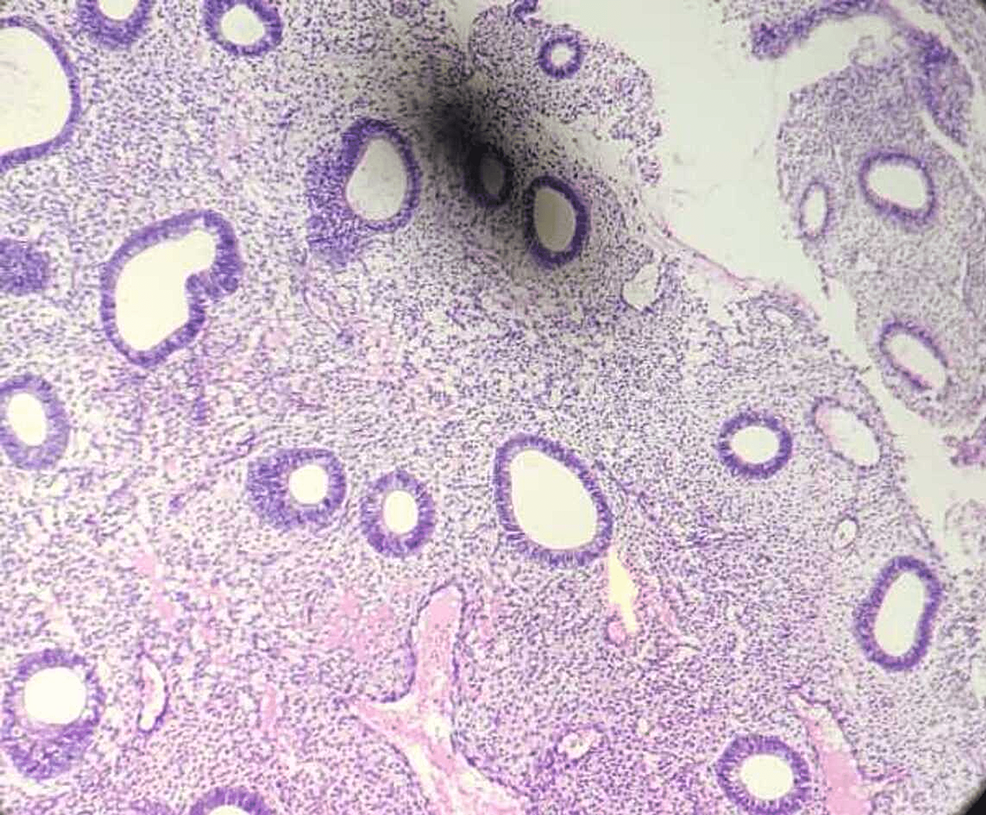 Cureus | Correlation of Morphological Findings of Endometrium With ...