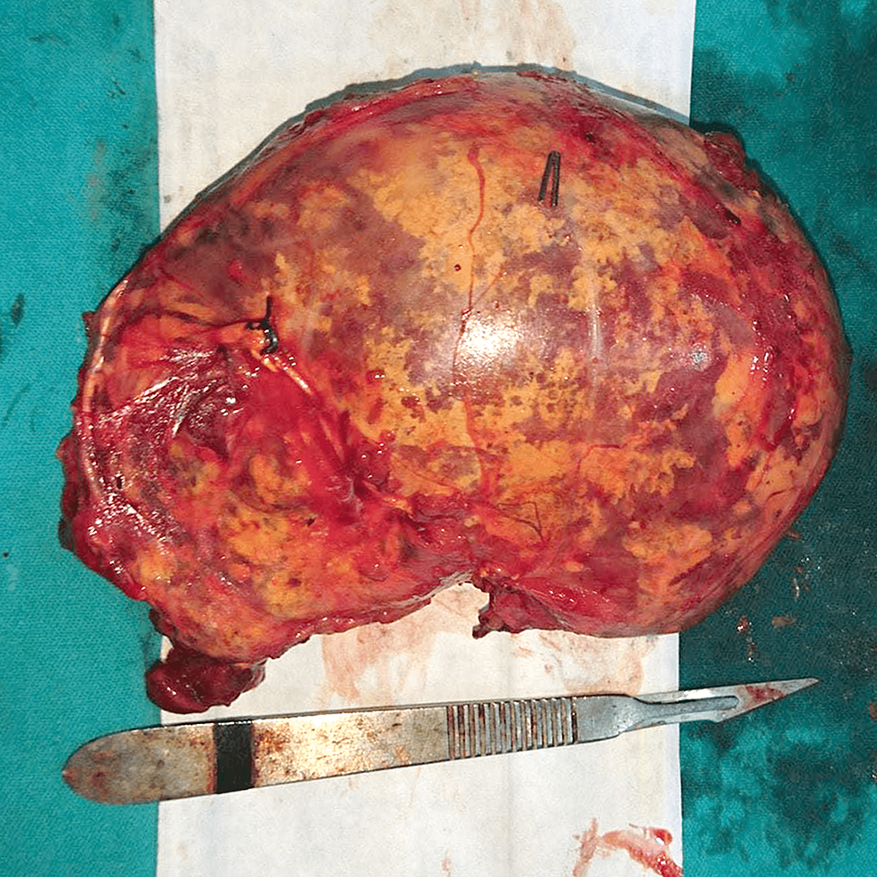 Gross-examination-of-the-resected-specimen-showing-the-large-encapsulated-mass