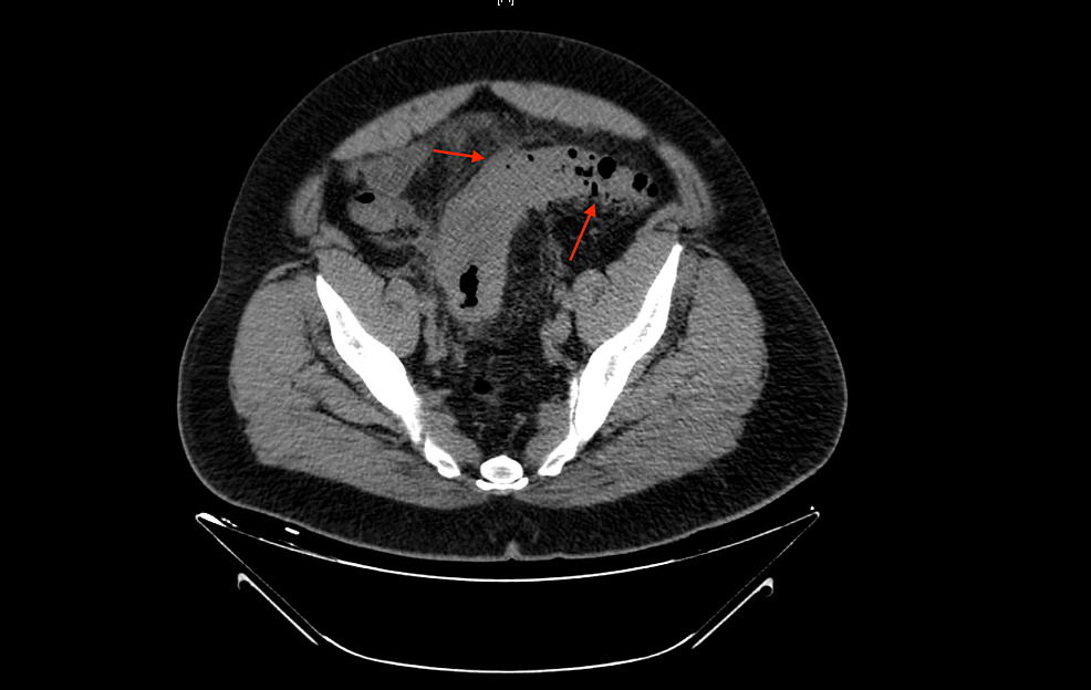 Complicated Diverticulitis With Associated Small Bowel Obstruction A