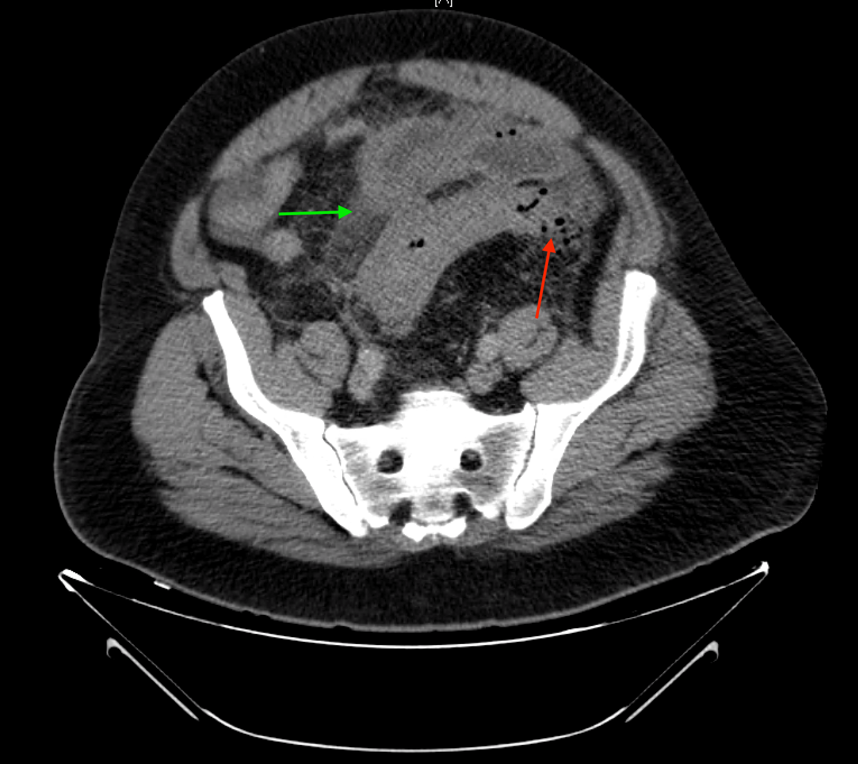 Cureus Complicated Diverticulitis With Associated Small Bowel