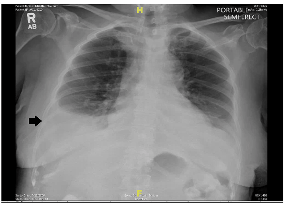 Chest-radiograph-showing-right-pleural-effusion-(black-arrow).
