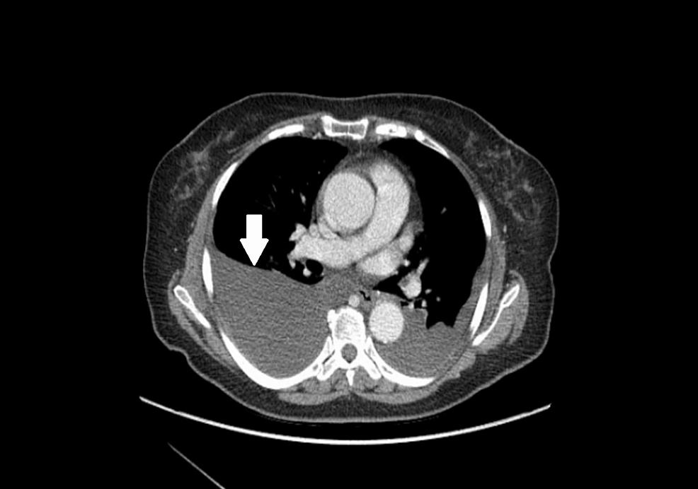 CT-scan-of-the-chest:-axial-view-showing-right-pleural-effusion-greater-(white-arrow)-than-left.