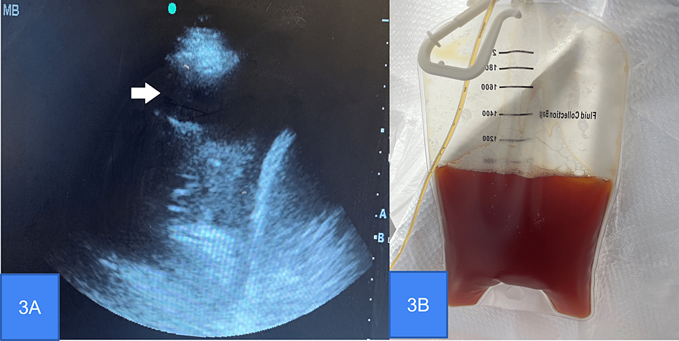 (A)-Ultrasound-image-showing-pleural-effusion-(white-arrow);-(B)-Pleural-drainage-post-thoracentesis-showing-serosanguineous-pleural-effusion.