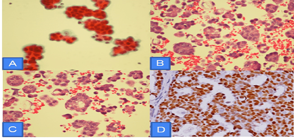 (A)-Pleural-fluid-cell-block-showing-cluster-of-single-and-group-of-atypical-malignant-cells-with-papillary-configuration,-consistent-with-endometrial-adenocarcinoma-as-primary;-(B,-C)-H&amp;E-x400-malignant-cells-with-papillary-serous-endometrial-carcinoma;-(D)-Immunohistochemical-stain-positive-for-estrogen-receptors.