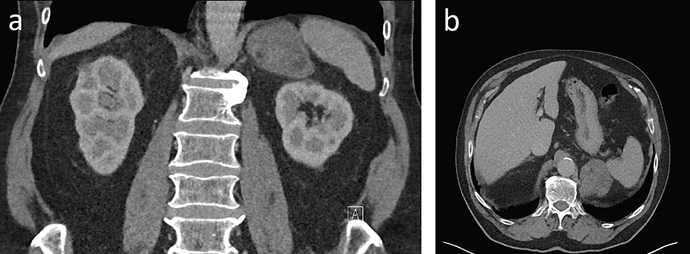 A Rare Case of Cavernous Haemangioma of the Adrenal Gland: A Case Report and Review of Literature