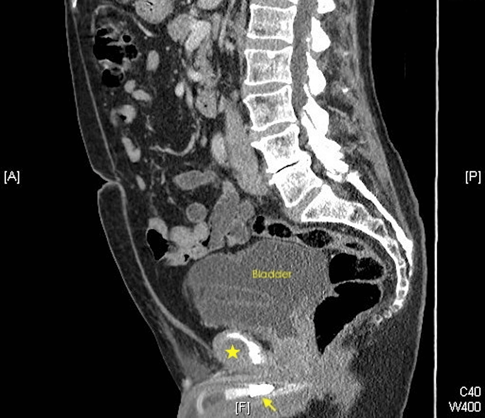 Computed tomography (sagittal view) - scan - illustration - penis - prosthesis - (yellow arrow), - and - group - fluids - site - (star).