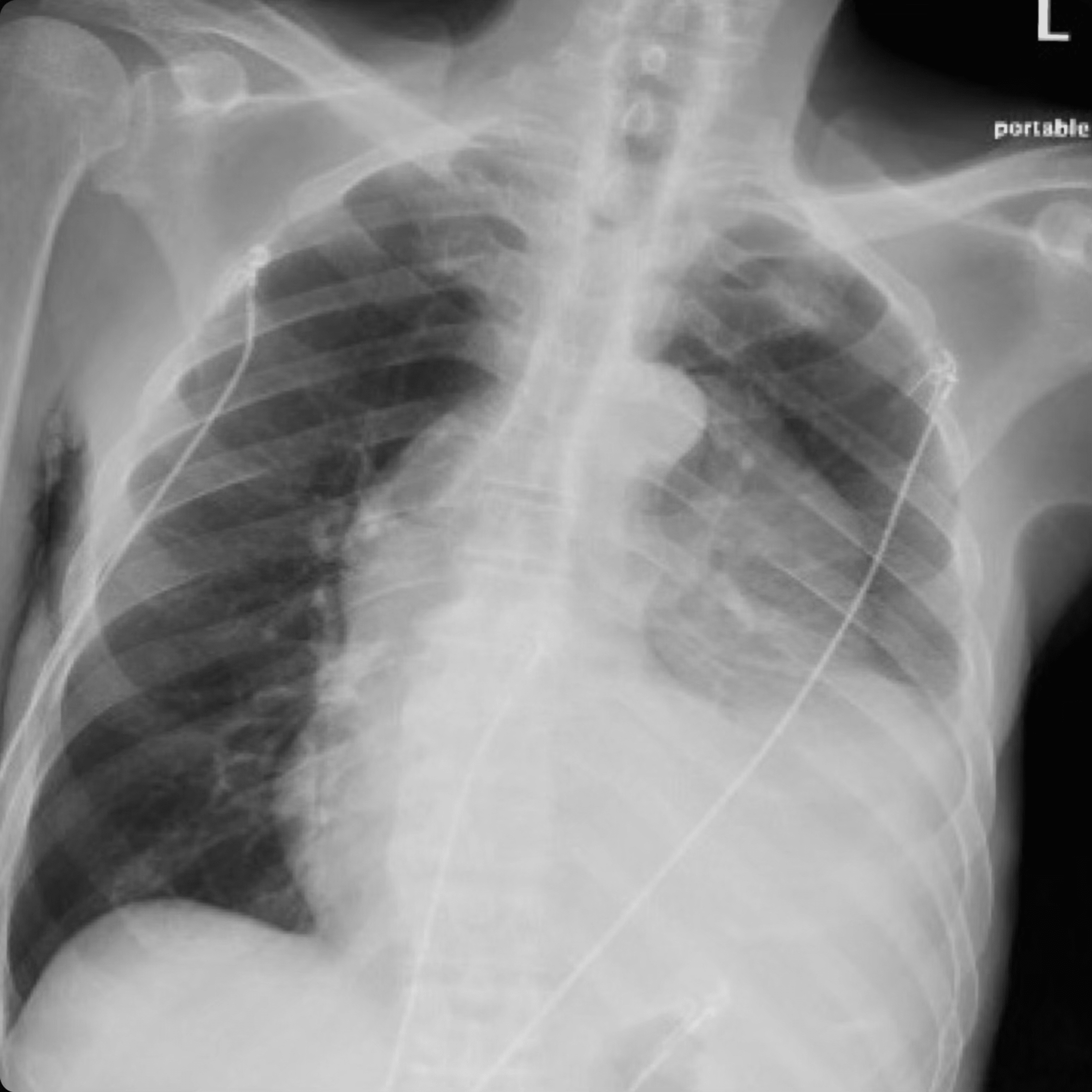 Cureus | A Rare Case of Blood Culture-Negative Isolated Pulmonic Valve ...