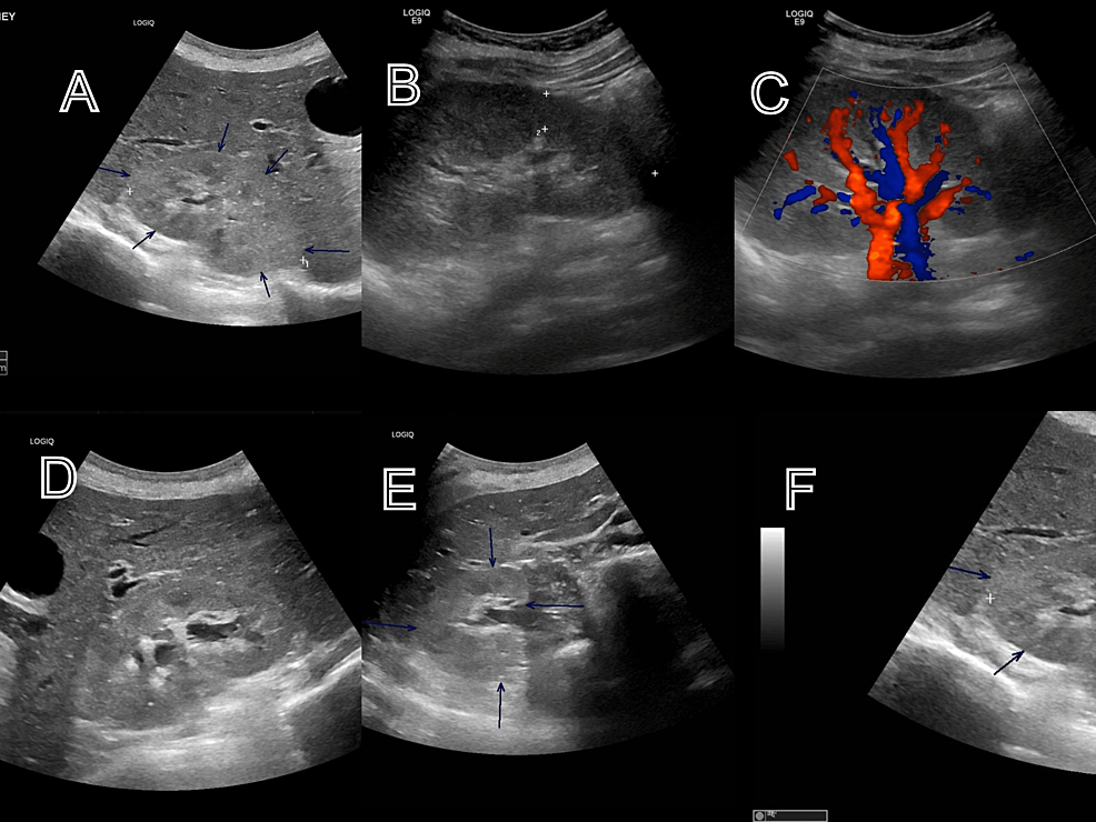Renal-ultrasound-with-arrows-showing-some-features-of-pyelonephritis