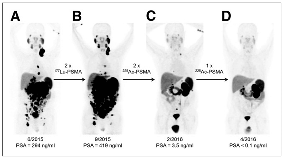 A Review Of 177Lutetium-PSMA And 225Actinium-PSMA As Emerging ...