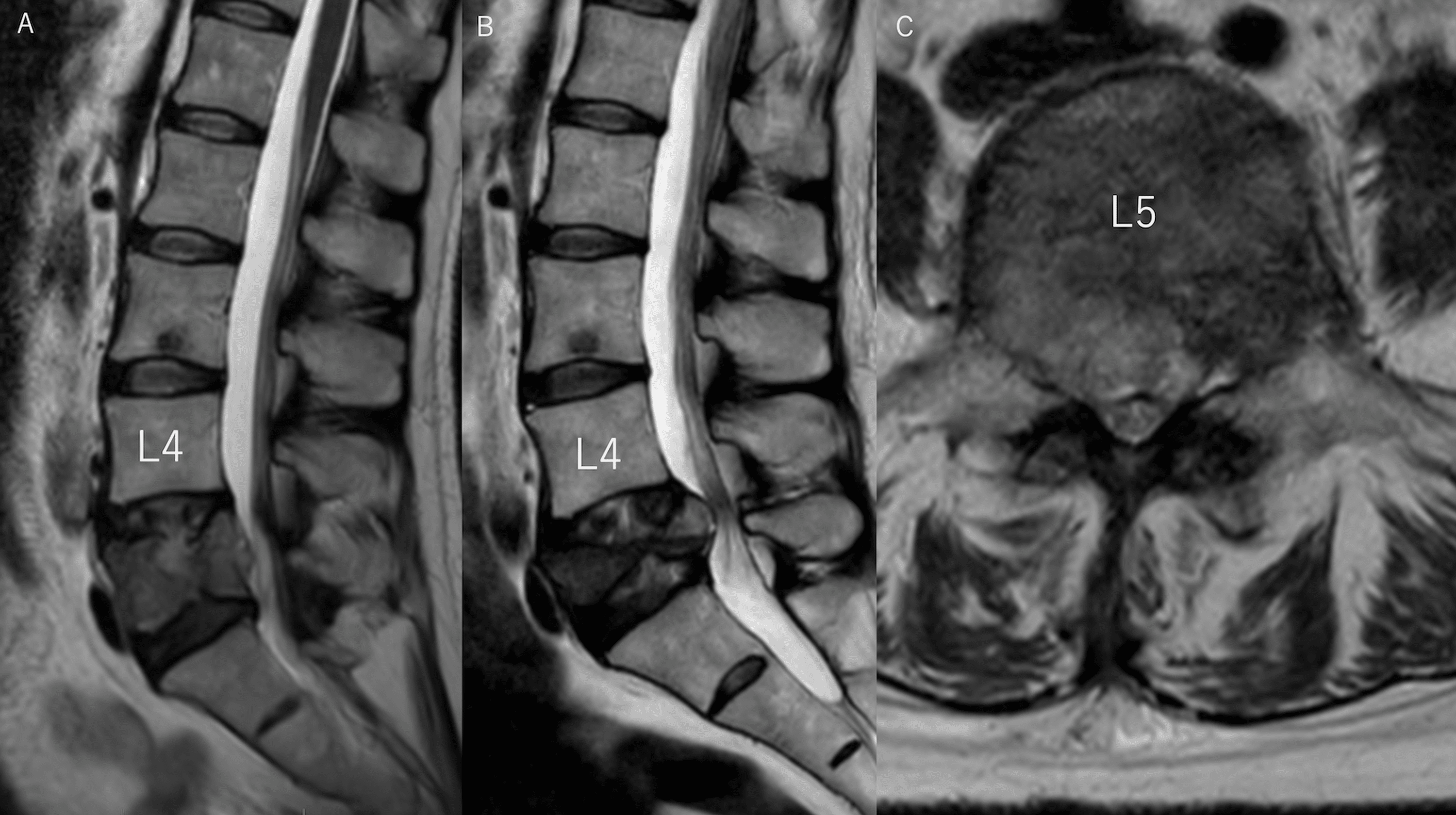 Cureus | Traction Radiculopathy After Surgery for Lumbar Spinal ...