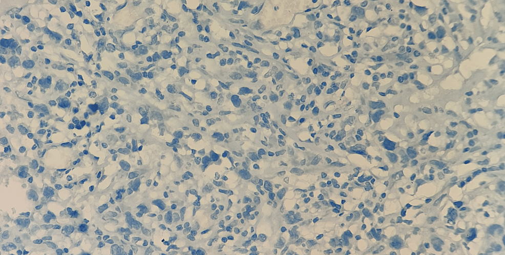 Immunostains-showing-the-cells-are-negative-for-ALK-(400-x)
